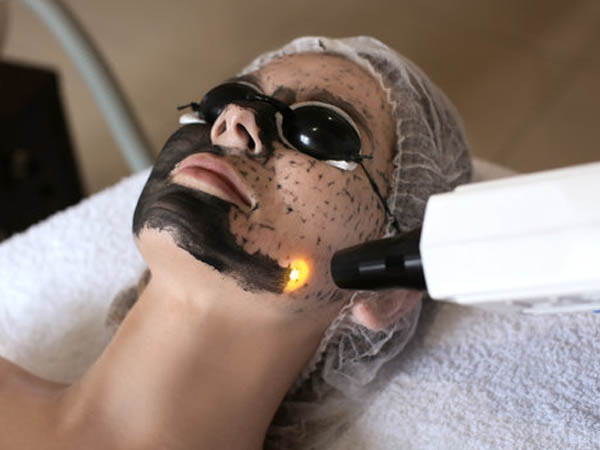 Peeling de Carbono na Vila Anhanguera | Santo Amaro | Campo Grande | Interlagos | Avenida Nossa Sra Sabará | Marajoara | Giselle Oliveira Laser